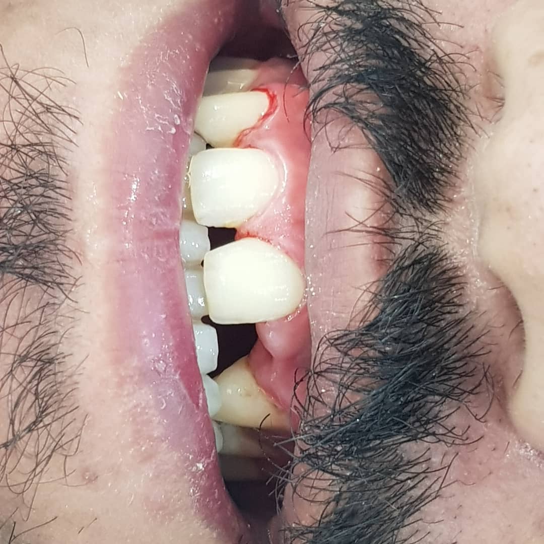 قبل